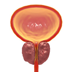 Benign prostatic hyperplasia, 3D illustration showing enlarged prostate gland - obrazy, fototapety, plakaty