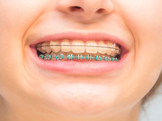 Fototapeta premium Stock photo of the ceramic braces