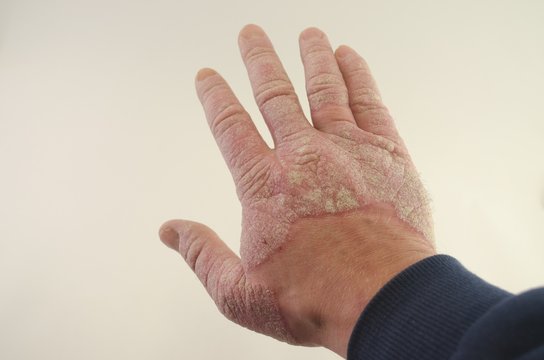 exacerbation of psoriasis in the hands