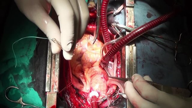 Human heart surgery professional doctor hands unique macro video in clinic. Struggle for life. Operation on live organ of patient in hospital.