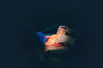 Surgeon hands with white sterile gloves operate with an electric scalpel or cauter electrosurgical,...