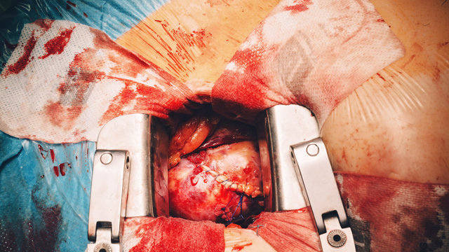 Open heart surgery - heart suture detail close-up of heart open