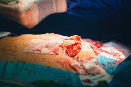 Surgeon hands with white sterile gloves operate with an electric scalpel or cauter electrosurgical, resecting a tumor, using surgery operation room remove cancer tumor surgery