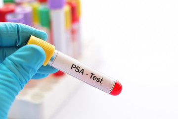 Blood sample for PSA (prostate specific antigen) test, diagnosis for prostate cancer - obrazy, fototapety, plakaty