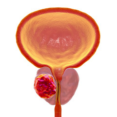 Prostate cancer, 3D illustration showing presence of tumor inside prostate gland which compresses urethra