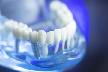 Dental teeth decay model