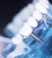 Dentsts dental tooth implant