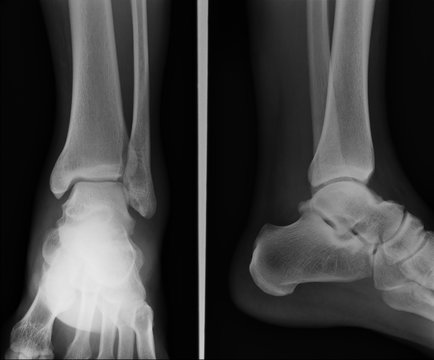 x ray ankle ap lateral