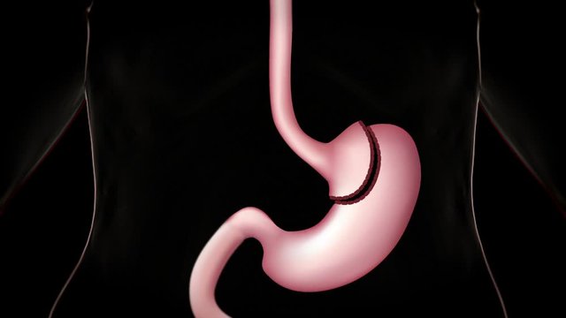 RNY Gastric bypass surgery procedure, animation