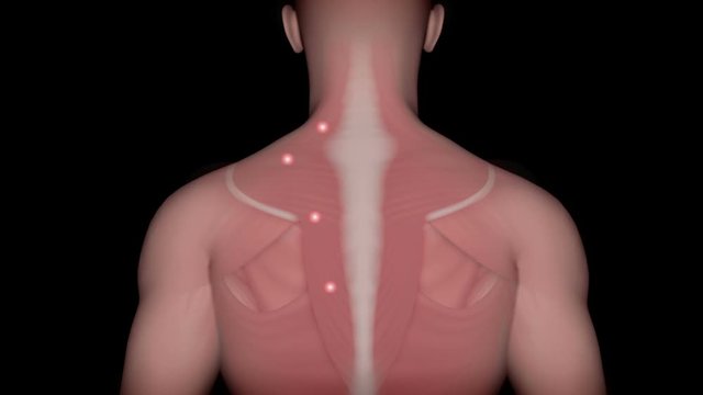 Trigger points and referred pain, animation
