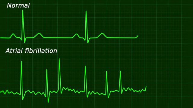 Atrial fibrillation ECG loop animation