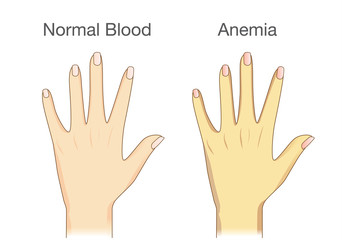 Obraz premium The effect of Anemia on skin blood flow in human. Compared color of people arm.