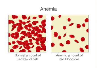 The difference of normal amount of red blood cell and Anemia. Illustration about medical.
