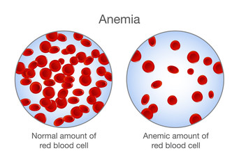 The difference of Anemia amount of red blood cell and normal. Illustration about medical. - obrazy, fototapety, plakaty