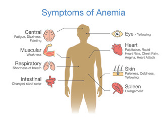 The most common Symptom of Anemia. Illustration about medical diagram for diagnose a disease or condition.