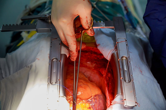 human heart during cardiac surgery transplantation. Surgeon view