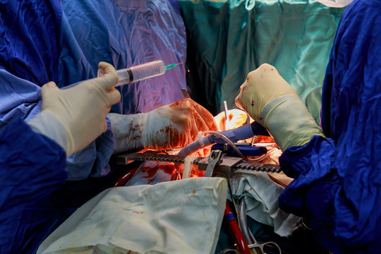 Surgeon hands are tying a knot during the open heart procedure