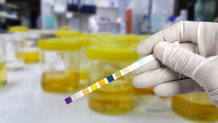 Hand in white glove holding urine strip positive leukocyte esterase for diagnosis urinary tract infection with blur background. - obrazy, fototapety, plakaty