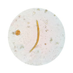 Stool parasites examination test for parasites or eggs in human stool sample with iodine stained...