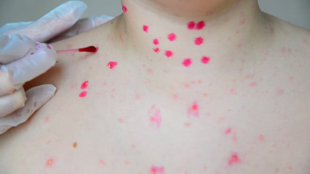 Вoctor to treat rash with chicken pox