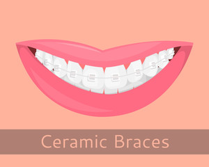 Dental braces, smiling lips in cartoon style isolated. Smile with braces, illustration on the topic of stomatology, orthodontics, teeth alignment, bite correction, vector illustration