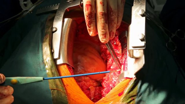 Beating human heart close-up in opened chest during the surgery