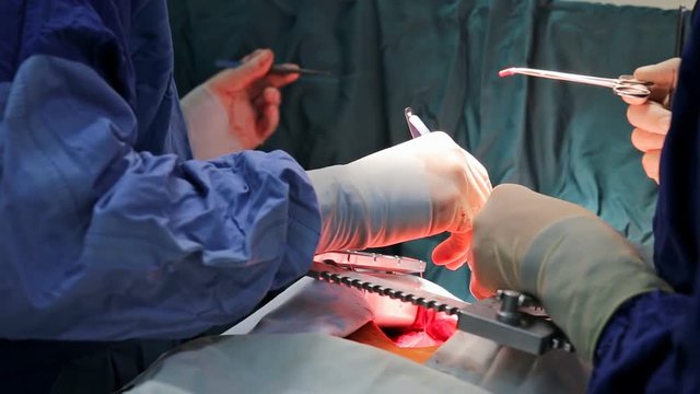 human heart during cardiac surgery transplantation. Surgeon view