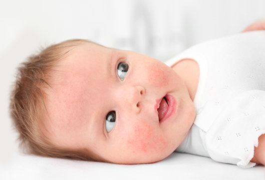 Adorable baby with skin allergy on light background