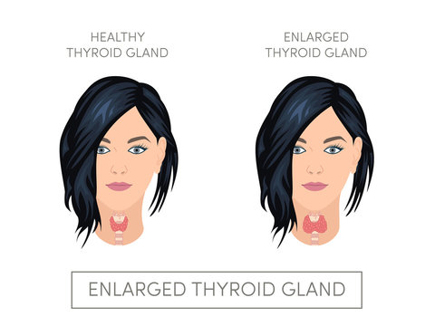 Female with normal and enlarged thyroid gland