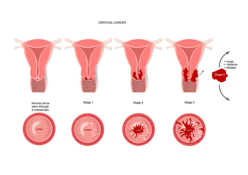 Cervical cancer and its various stages