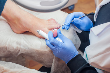 Podology treatment. Podiatrist treating toenail fungus. Doctor removes calluses, corns and treats ingrown nail. Hardware manicure. Health, body care concept. Selective focus - obrazy, fototapety, plakaty