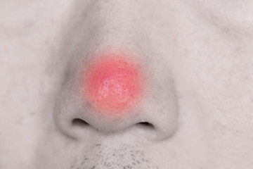 Nose Acne tip in male closeup