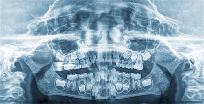 Panoramic X-Ray teeth of a child