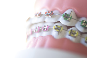 Cosmetic dental metal brackets