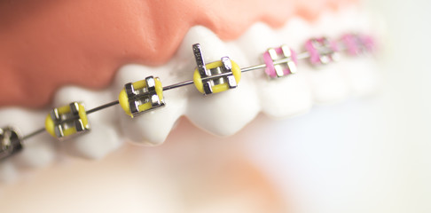 Cosmetic dental metal brackets