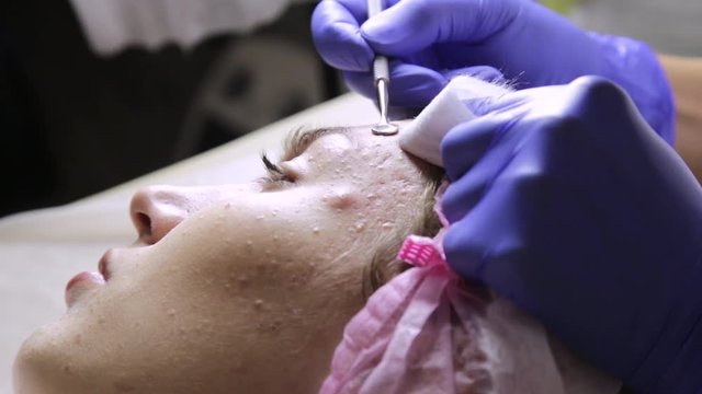 beautician squeezing pimple blackheads for young wonan in beauty salon. facial skin care