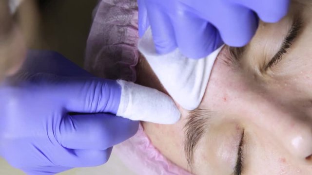 Squeezing pimple acne treatments. Young woman receiving beauty face therapy of cleaning pimple.