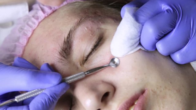 beautician squeezing pimple blackheads for young wonan in beauty salon. facial skin care