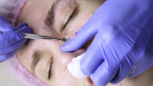 Squeezing pimple acne treatments. Young woman receiving beauty face therapy of cleaning pimple.