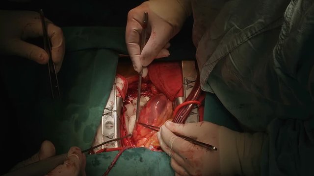 heart surgery