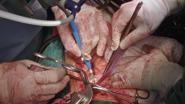 Vascular surgeon team replace infrarenal aorta for patient who had abdominal aortic aneurysm