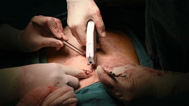 General surgeon perform appendectomy for patient who had appendicitis