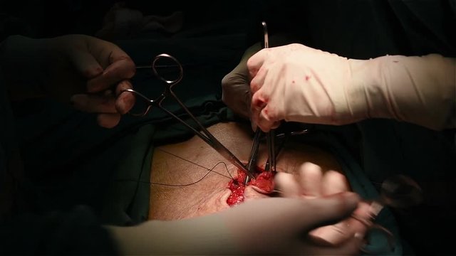 General surgeon perform appendectomy for patient who had appendicitis