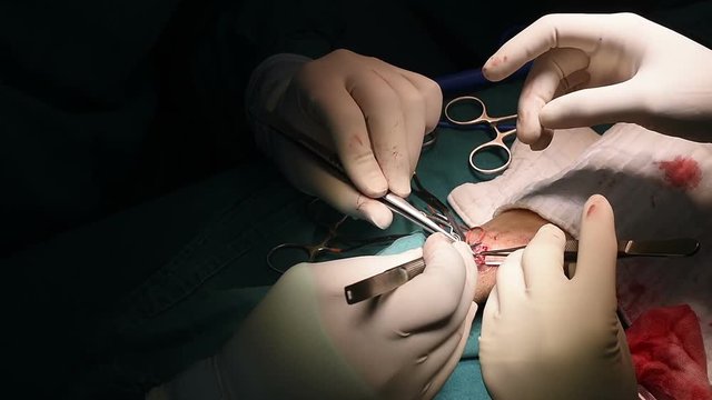 General surgeon perform appendectomy for patient who had appendicitis