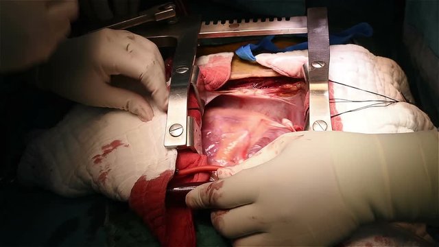 open heart surgery