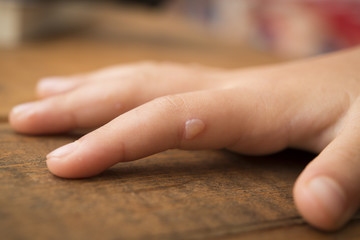 Hand-foot-and-mouth disease