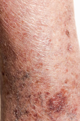 Fototapeta premium Close-up of skin with varicose veins