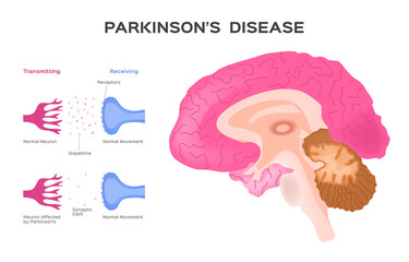 Parkinson's Affected neuron . Graphic  vector