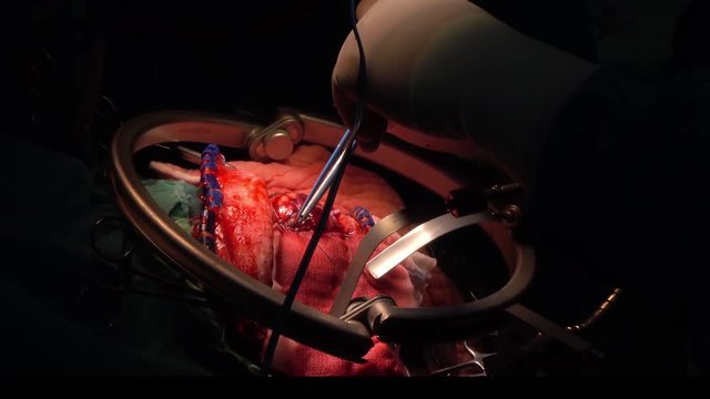 brain surgery