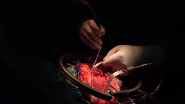 brain surgery